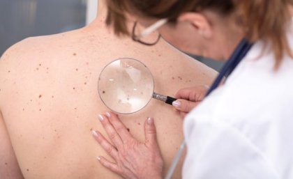 A person in a white coat and goggles is using a magnifying glass to examine spots on a person's back.